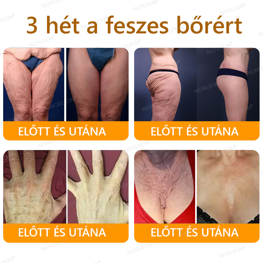 ✨✨FDA által jóváhagyva: 𝐍𝐎𝐑𝐔𝐈𝐎𝐍® 𝐌é𝐡𝐦é𝐫𝐞𝐠 𝐁ő𝐫𝐦𝐞𝐠ú𝐣í𝐭ó 𝐊𝐫é𝐦 — 🔥𝐊𝐨𝐫𝐥á𝐭𝐨𝐳𝐨𝐭𝐭 𝐢𝐝𝐞𝐢𝐠 𝟕𝟎% 𝐤𝐞𝐝𝐯𝐞𝐳𝐦é𝐧𝐲🔥