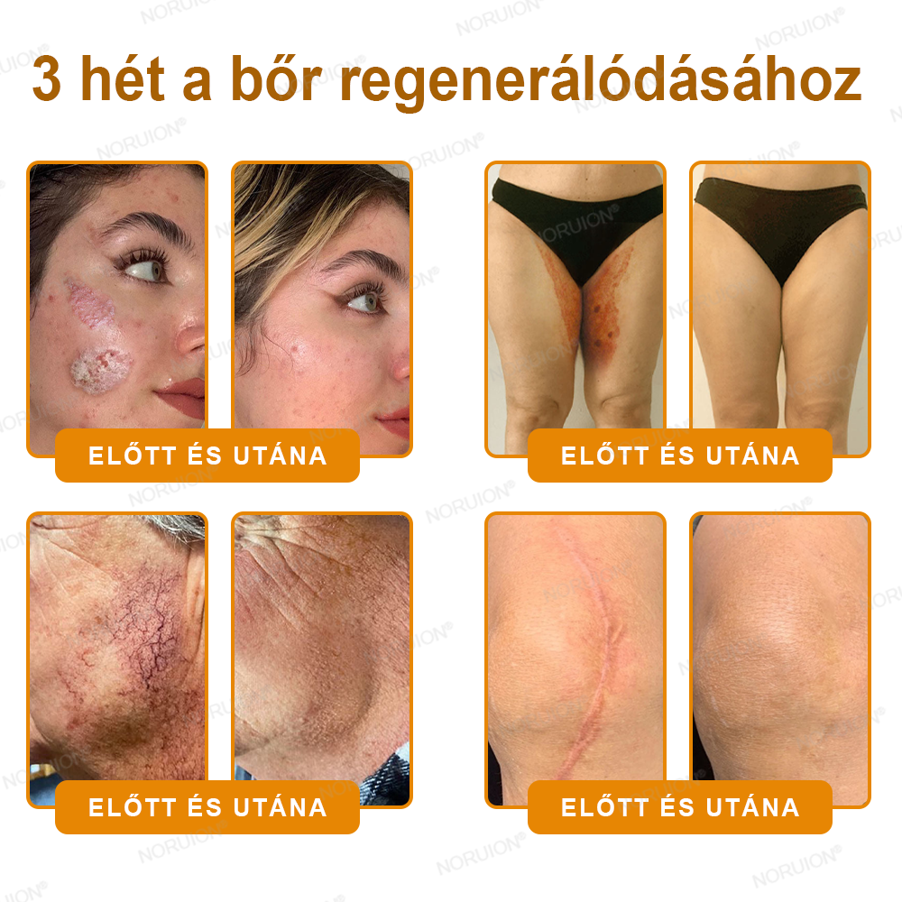 ✨✨FDA által jóváhagyva: 𝐍𝐎𝐑𝐔𝐈𝐎𝐍® 𝐌é𝐡𝐦é𝐫𝐞𝐠 𝐁ő𝐫𝐦𝐞𝐠ú𝐣í𝐭ó 𝐊𝐫é𝐦 — 🔥𝐊𝐨𝐫𝐥á𝐭𝐨𝐳𝐨𝐭𝐭 𝐢𝐝𝐞𝐢𝐠 𝟕𝟎% 𝐤𝐞𝐝𝐯𝐞𝐳𝐦é𝐧𝐲🔥
