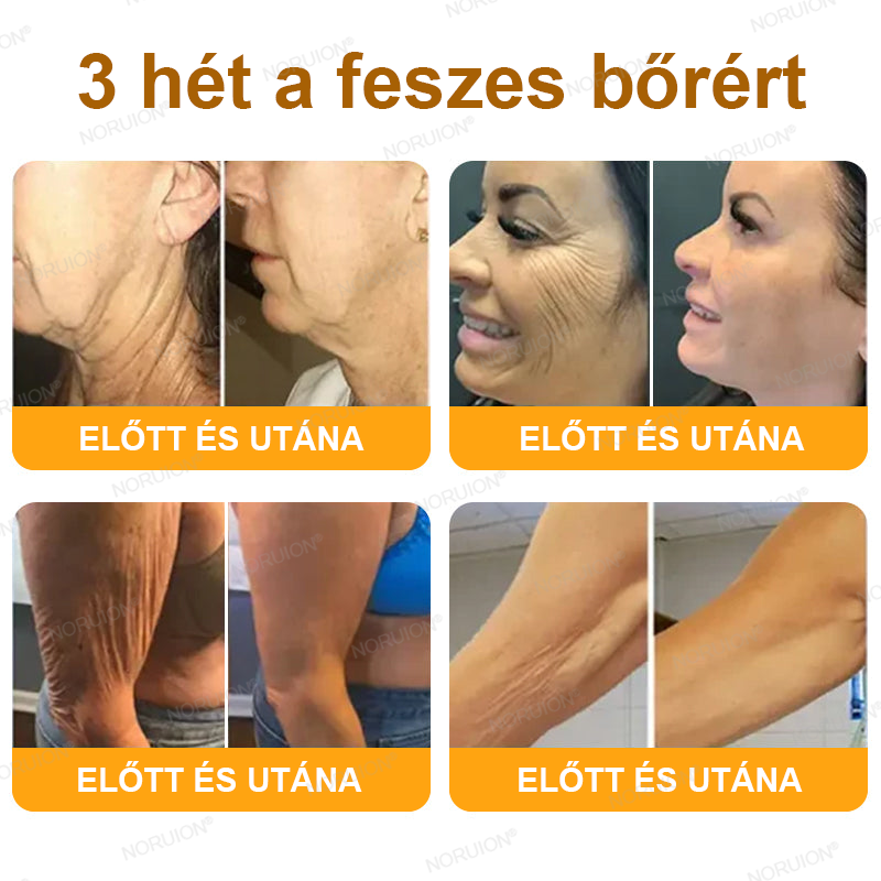 ✨✨FDA által jóváhagyva: 𝐍𝐎𝐑𝐔𝐈𝐎𝐍® 𝐌é𝐡𝐦é𝐫𝐞𝐠 𝐁ő𝐫𝐦𝐞𝐠ú𝐣í𝐭ó 𝐊𝐫é𝐦 — 🔥𝐊𝐨𝐫𝐥á𝐭𝐨𝐳𝐨𝐭𝐭 𝐢𝐝𝐞𝐢𝐠 𝟕𝟎% 𝐤𝐞𝐝𝐯𝐞𝐳𝐦é𝐧𝐲🔥