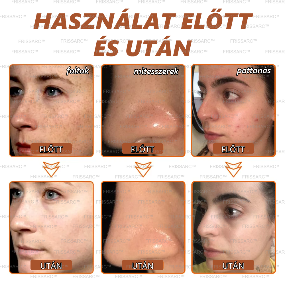 👩‍⚕️👩‍⚕️𝐅𝐑𝐈𝐒𝐒𝐀𝐑𝐂™ Fehérítő És Folteltávolító Arcmaszk | Természetes összetevők tartósan eltüntetik a foltokat, szeplőket és napfoltokat🔥