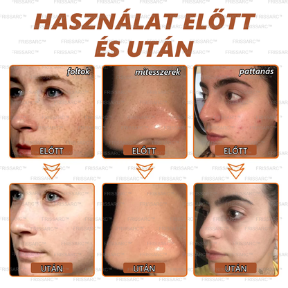 👩‍⚕️👩‍⚕️𝐅𝐑𝐈𝐒𝐒𝐀𝐑𝐂™ Fehérítő És Folteltávolító Arcmaszk | Természetes összetevők tartósan eltüntetik a foltokat, szeplőket és napfoltokat🔥