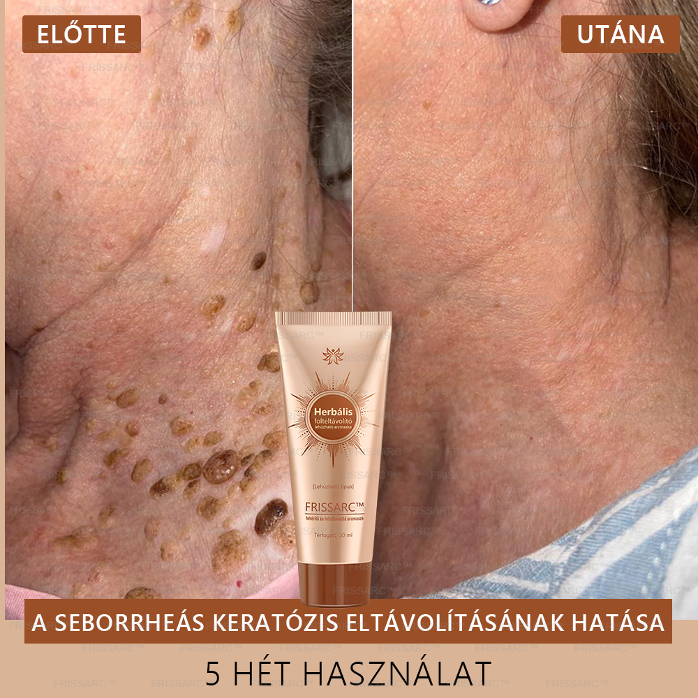 👩‍⚕️👩‍⚕️𝐅𝐑𝐈𝐒𝐒𝐀𝐑𝐂™ Fehérítő És Folteltávolító Arcmaszk | Természetes összetevők tartósan eltüntetik a foltokat, szeplőket és napfoltokat🔥