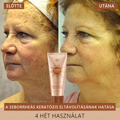 👩‍⚕️👩‍⚕️𝐅𝐑𝐈𝐒𝐒𝐀𝐑𝐂™ Fehérítő És Folteltávolító Arcmaszk | Természetes összetevők tartósan eltüntetik a foltokat, szeplőket és napfoltokat🔥