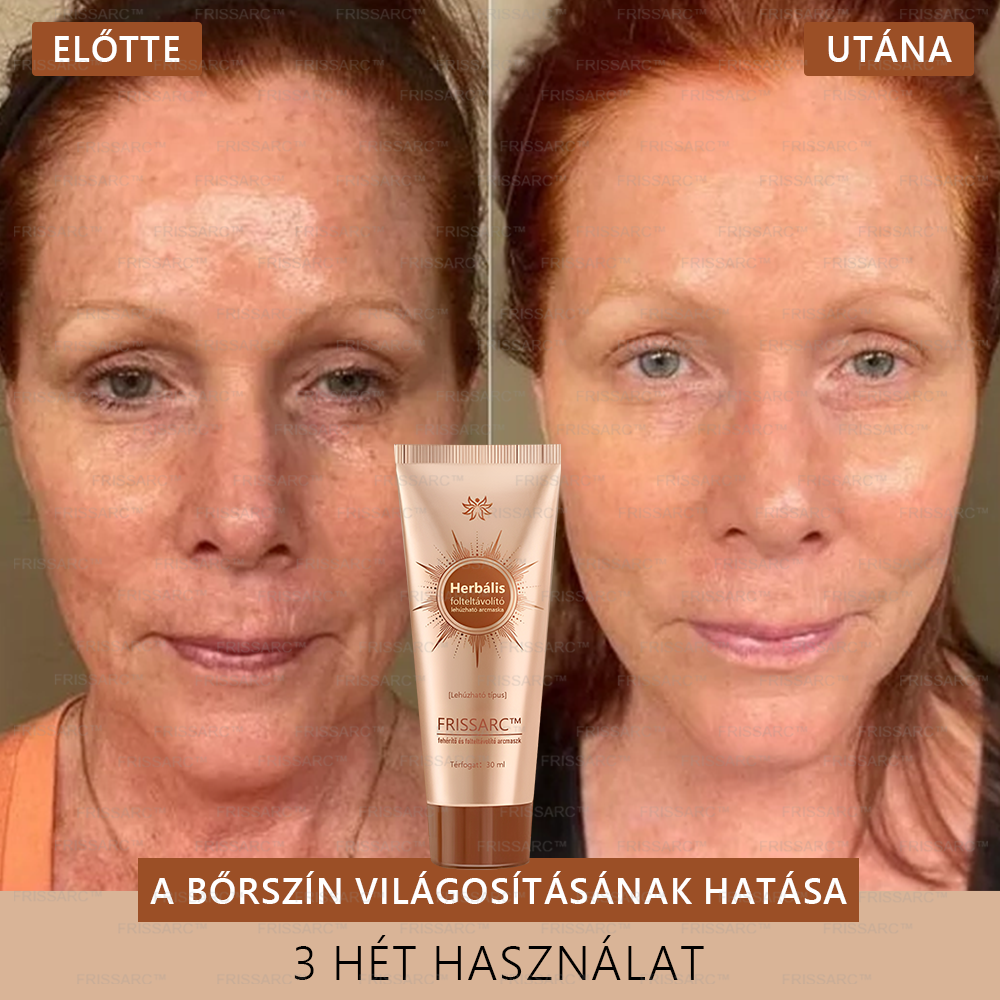 👩‍⚕️👩‍⚕️𝐅𝐑𝐈𝐒𝐒𝐀𝐑𝐂™ Fehérítő És Folteltávolító Arcmaszk | Természetes összetevők tartósan eltüntetik a foltokat, szeplőket és napfoltokat🔥