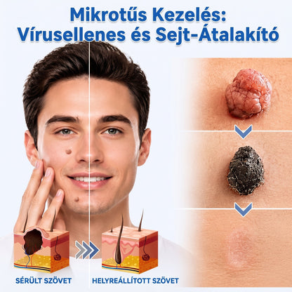 ✨✨ 2 az 1-ben mikrotűs és hidrokolloid tapasz🍀 | Kiálló anyajegyek, aknék, lapos szemölcsök és bőrnövedékek eltávolítására | Segít csökkenteni a ráncokat, hegeket és bőrhibákat | Láthatatlan tapasz az arcra és testre