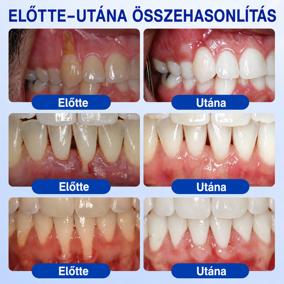 🇭🇺👨‍⚕️👨‍⚕️✅🦷 PuraCure® ÍNYMEGÚJÍTÓ – Parodontális helyreállító gél🧂