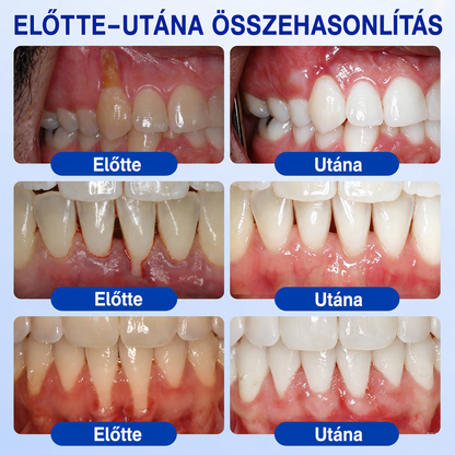 🇭🇺👨‍⚕️👨‍⚕️✅🦷 PuraCure® ÍNYMEGÚJÍTÓ – Parodontális helyreállító gél🧂